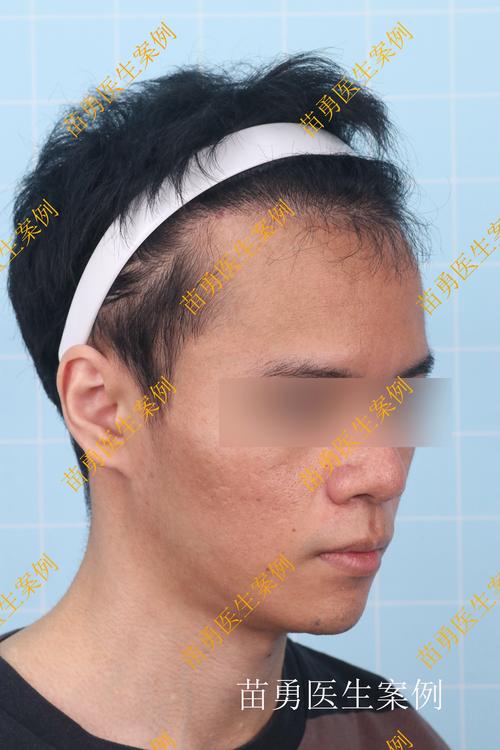 2026伊犁医疗美容价格参考：头顶加密多少钱？正规机构选择与
