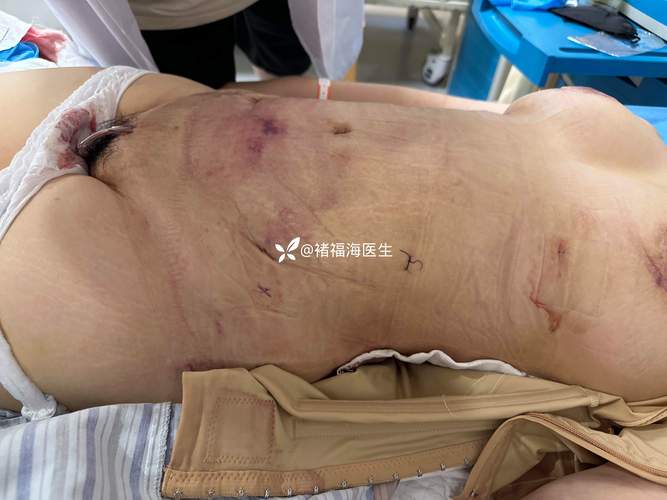 喀什腹壁成形前十医院排名及2026年价格参考 喀什腹壁成形前十医院排名及2026年价格参考