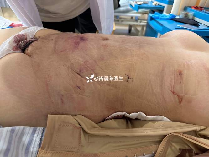 喀什腹壁成形前十医院排名及2026年价格参考 喀什腹壁成形前十医院排名及2026年价格参考