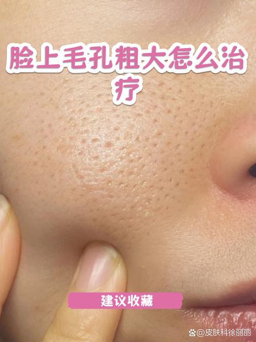 2026黔东南正规毛孔粗大治疗机构排行榜:正规医院推荐与避坑