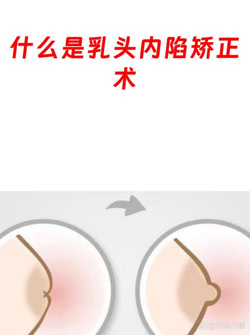 果洛乳头内陷矫正避坑指南:正规医院选择、价格参考与术后护理全
