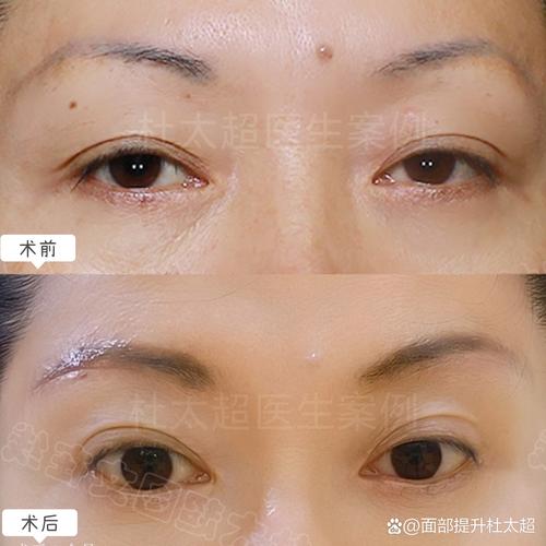 2026汉中切眉术哪家强?权威盘点正规医院前3强,价格与避坑