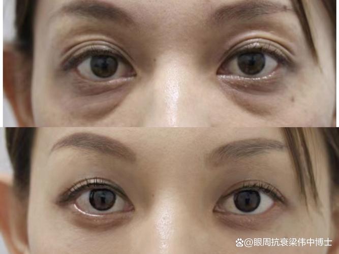 黔西南眼睑外翻矫正价格2026：正规医院怎么选？费用解析与避