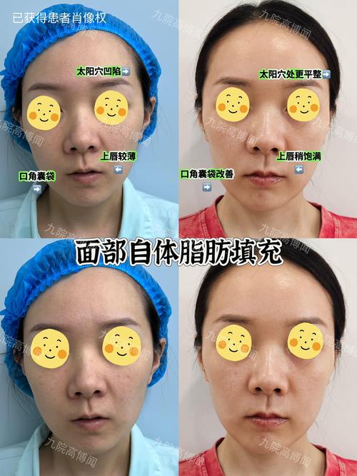 2026年自体脂肪丰额头推荐指南：和田地区医疗机构选择与价格