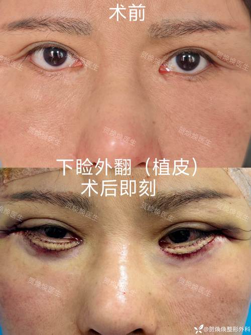 2026年扬州眼睑外翻矫正医院排名：正规机构推荐与价格避坑指