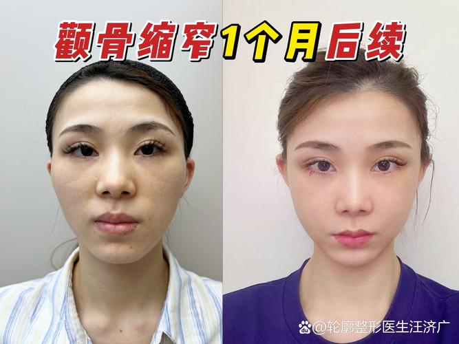2026恩施颧骨整形医院哪家强？正规机构推荐与价格费用参考