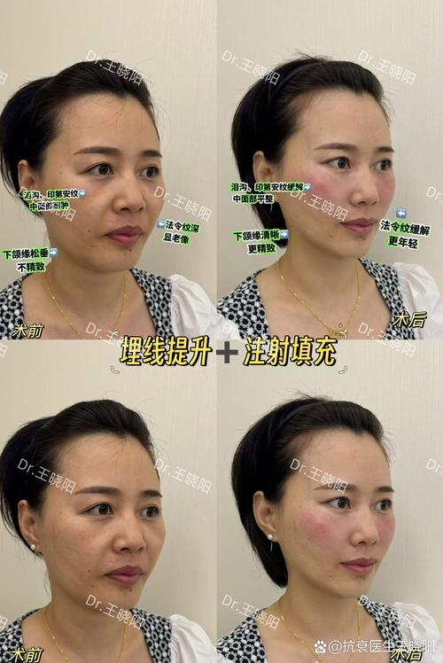 宁德埋线提升2026年正规医院推荐:前三强机构榜单与价格参考