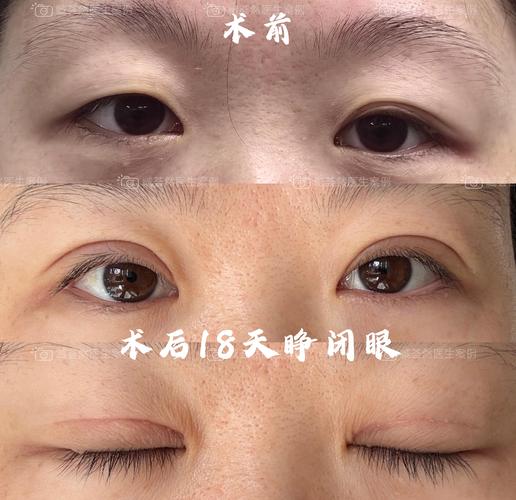 2026年周口切开双眼皮手术正规医院/医生十强榜单:价格、恢