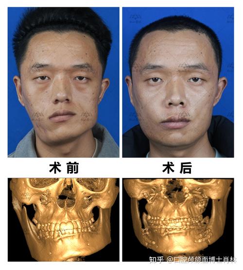 2026吉安削骨整形价格表参考：吉安磨骨正规医院排行榜与避坑