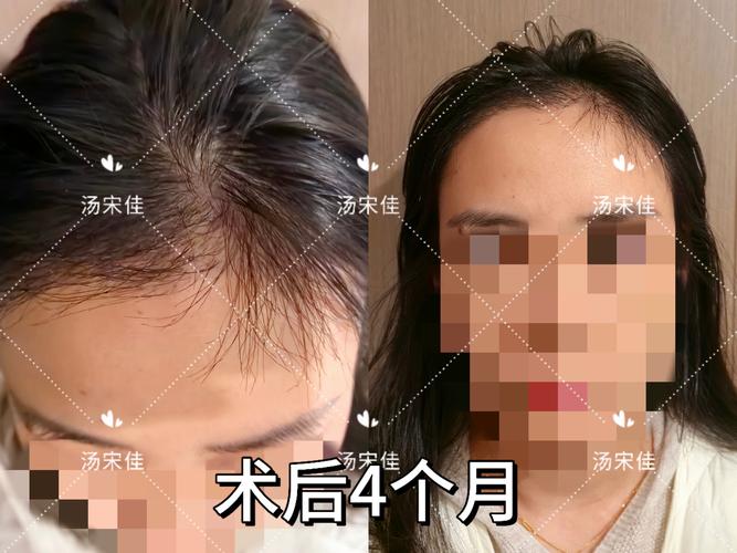 云浮发际线种植费用参考2026：正规医院价格表与避坑指南