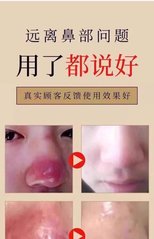 阿里酒糟鼻治疗价格多少钱？2026年正规医院收费标准与避坑指