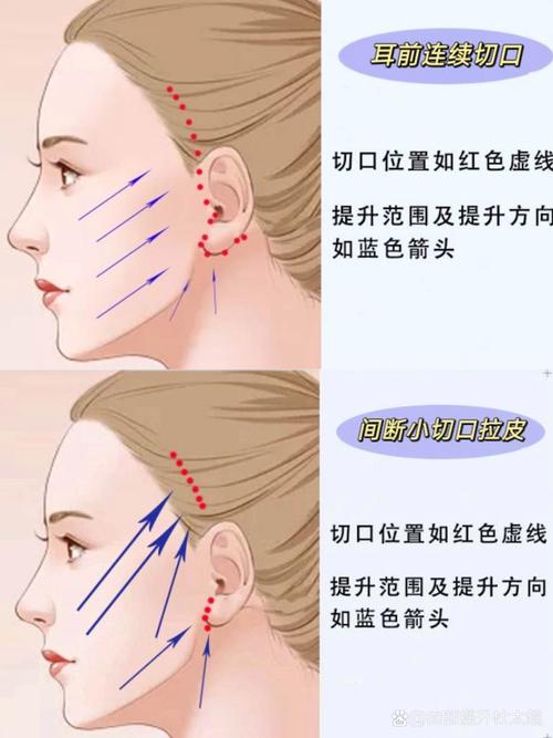 盘锦中面部提升推荐清单：2026热门项目原理、费用与机构排名