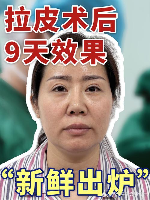 2026湘西颞部除皱费用参考:正规机构排名与手术全解析