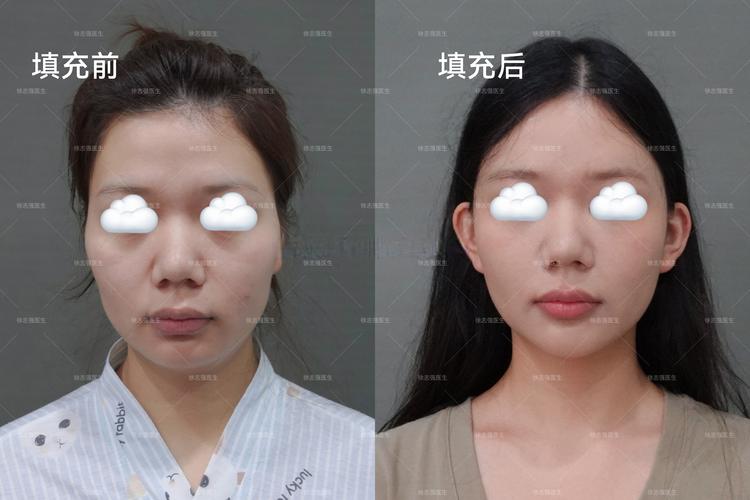 2026商丘自体脂肪丰下巴TOP3推荐:正规医院榜单、价格费