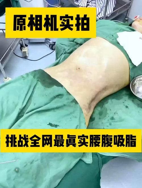2026岳阳腰腹吸脂TOP5推荐及价格表:专业医生资质与术后