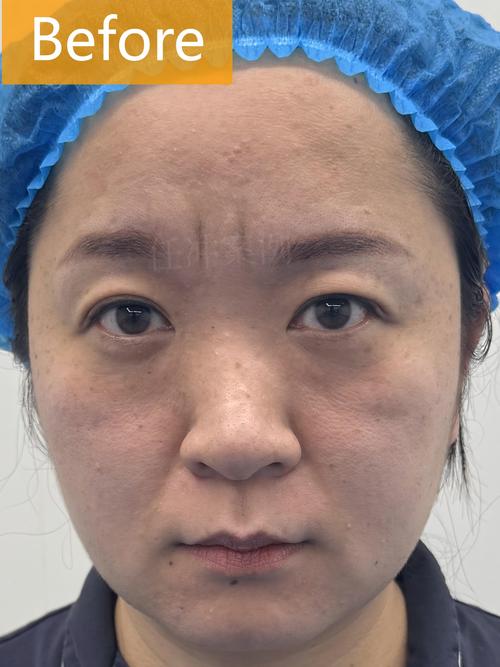 七台河眉毛种植前十推荐:2026微针技术解析、价格及恢复全攻