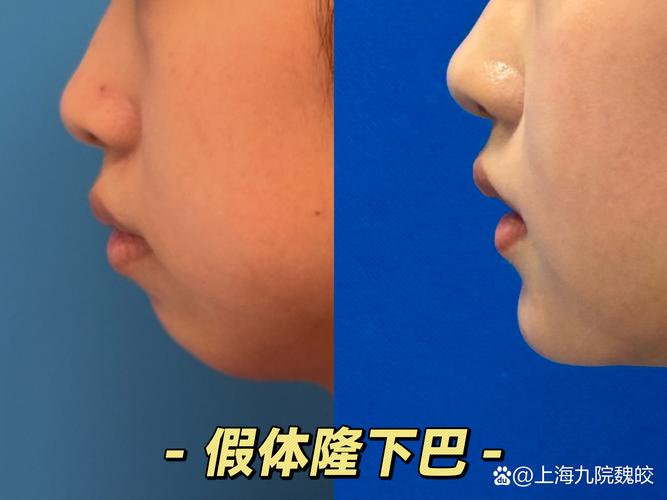 2026年白银假体隆下巴TOP5医院名单：正规机构推荐、价格