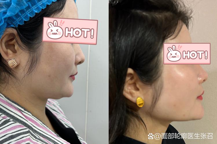 双鸭山双下巴吸脂哪家强?2026正规医院推荐、价格与恢复期全