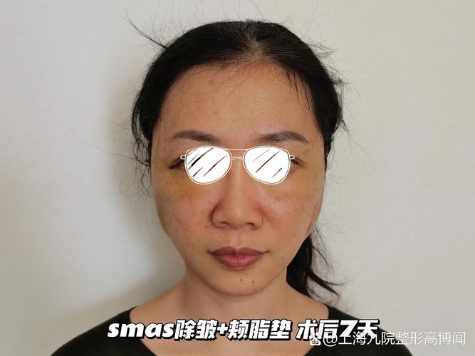 2026年三明颊脂垫去除医院推荐：正规医院TOP3盘点与价格