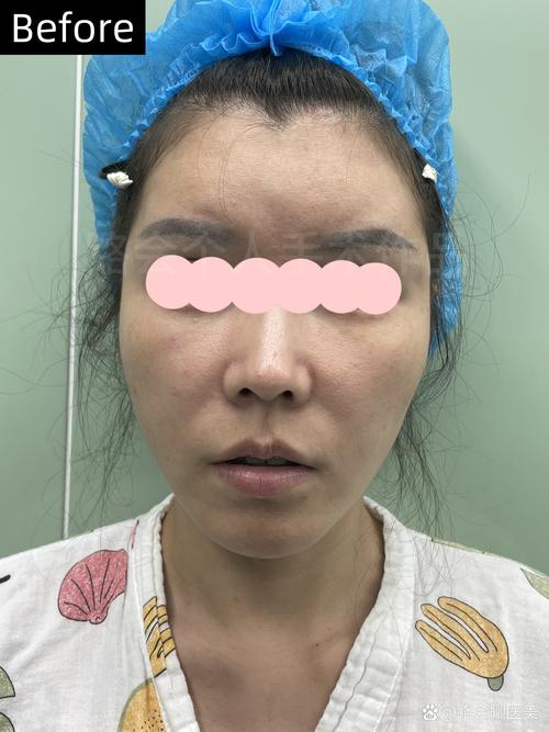 2026天水自体脂肪填充TOP3推荐：正规机构、存活率与价格