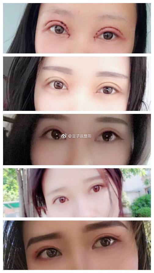 2026合肥切开双眼皮医院口碑排名TOP10:价格参考、恢复