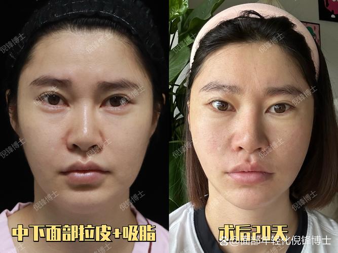 2026聊城面部吸脂哪家好?正规机构TOP5榜单与价格、恢复