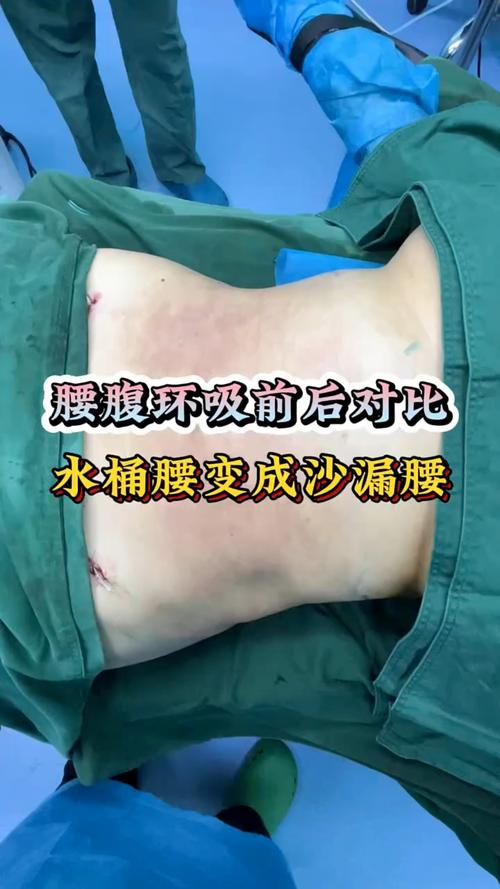 佳木斯腰腹环吸前3强榜单揭晓:2026价格参考、恢复期及术后