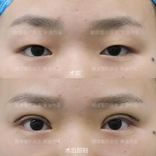 2026佳木斯切开双眼皮医院排名TOP5推荐:价格、技术、口