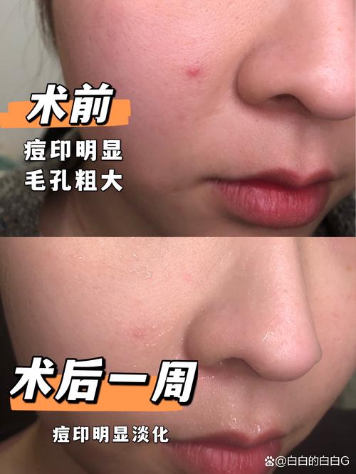 防城港微针水光哪家好？2026口碑前十机构推荐与避坑指南