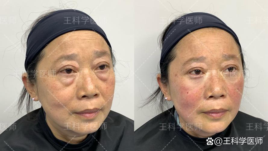 2026菏泽黑眼圈治疗TOP5推荐名单:专业机构与正规技术解