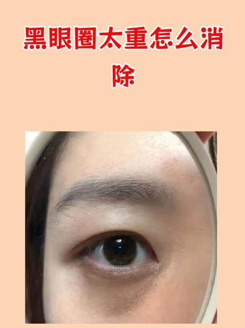 三明黑眼圈治疗排行推荐：2026年如何选正规机构与避坑指南