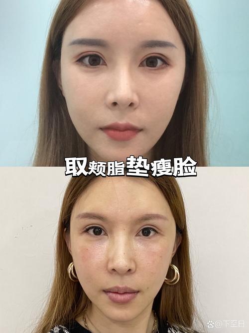 2026年南昌颊脂垫去除费用报价一览:正规医院口碑如何?多少