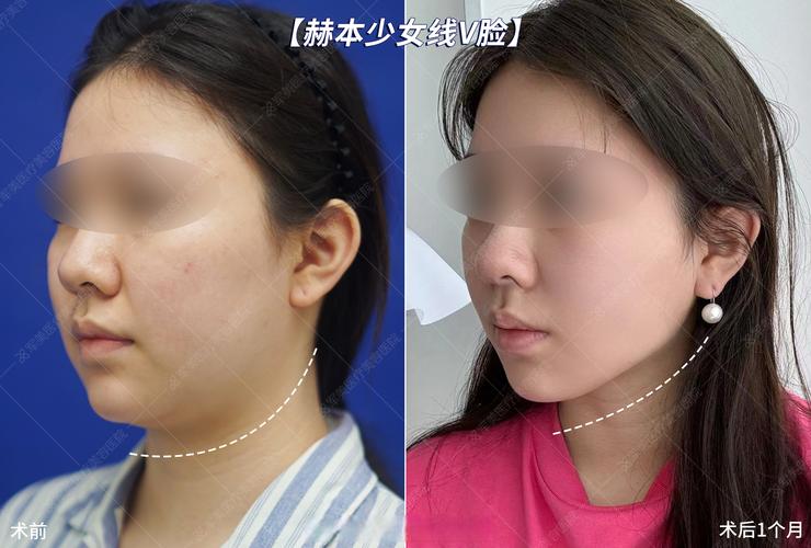 2026阿勒泰面部吸脂前三推荐：正规医院价格、恢复期及安全指