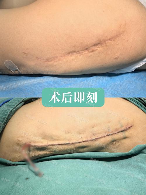 西宁疤痕切除5大正规医院推荐:专业去疤、价格透明,2026年