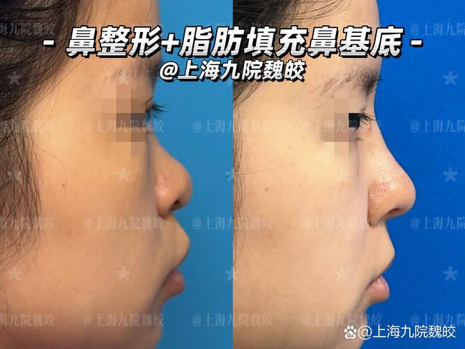 唐山玻尿酸填充鼻基底价格排行及材料选择指南