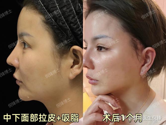 铜川面部吸脂排行2026版：正规机构推荐与价格费用详解