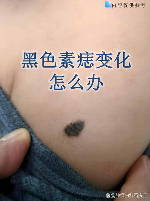 绍兴色素痣去除哪家强?2026正规机构推荐前3强及避坑指南