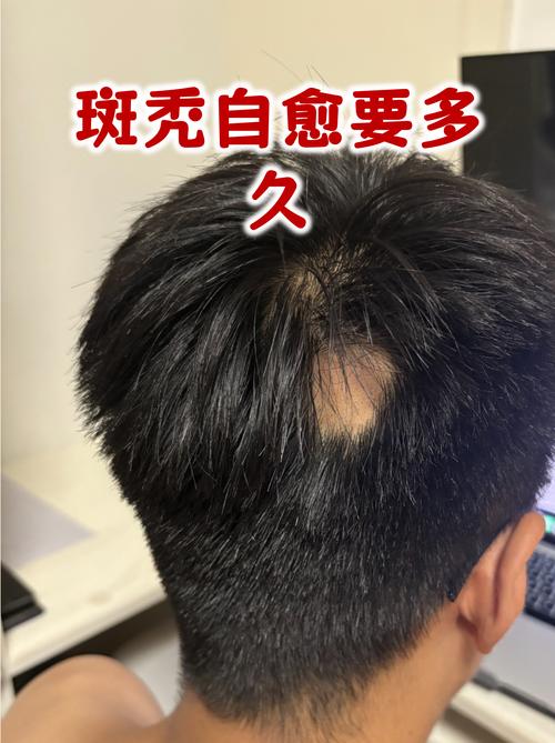 2026福州激光脱毛前3强盘点:价格、正规性及口碑推荐清单