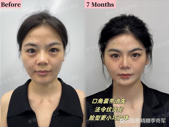 厦门下颌缘吸脂前5名盘点:价格、恢复期与机构资质全解析 厦门下颌缘吸脂前5名盘点:价格、恢复期与机构资质全解析