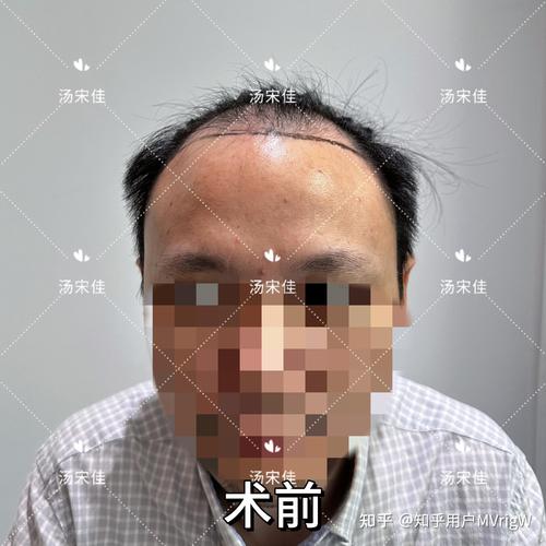 黔南头顶加密正规医院推荐 2026:技术与口碑并重,如何科学