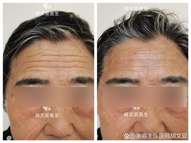 厦门额部除皱口碑推荐2026:专业解析提升原理、恢复期与价格