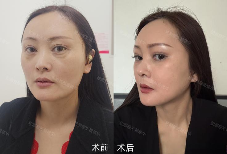 2026玉树面部轮廓整形医院排名及价格参考