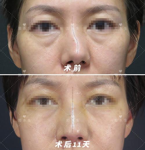 七台河歪鼻矫正多少钱？2026年整形医院价格表与正规医院推荐