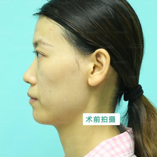 乌兰察布磨骨整形5大推荐:2026年正规医院名单与避坑指南