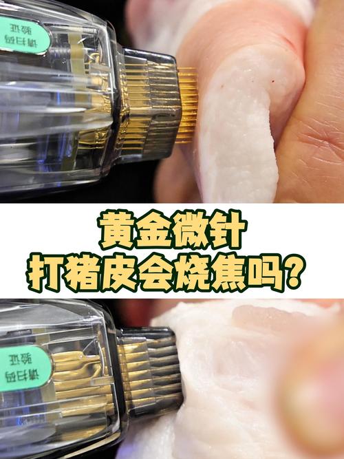 鹤岗黄金微针推荐2026:正规机构、价格与避坑指南