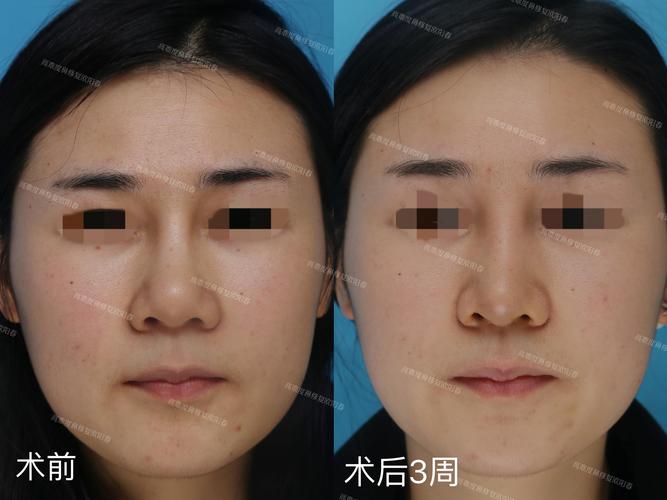 2026吕梁鼻部修复哪家好？正规机构避坑指南与专业选美攻略