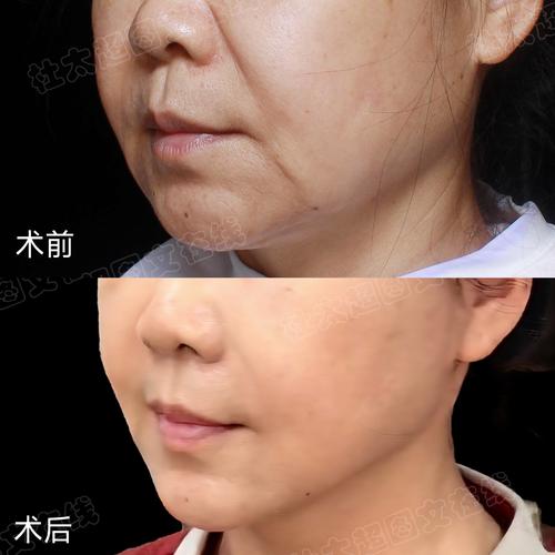新乡额部除皱避坑指南:2026正规医院推荐、口碑前十及费用参