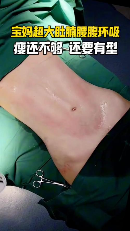 2026年白银腰腹环吸排行榜：正规机构推荐与价格参考