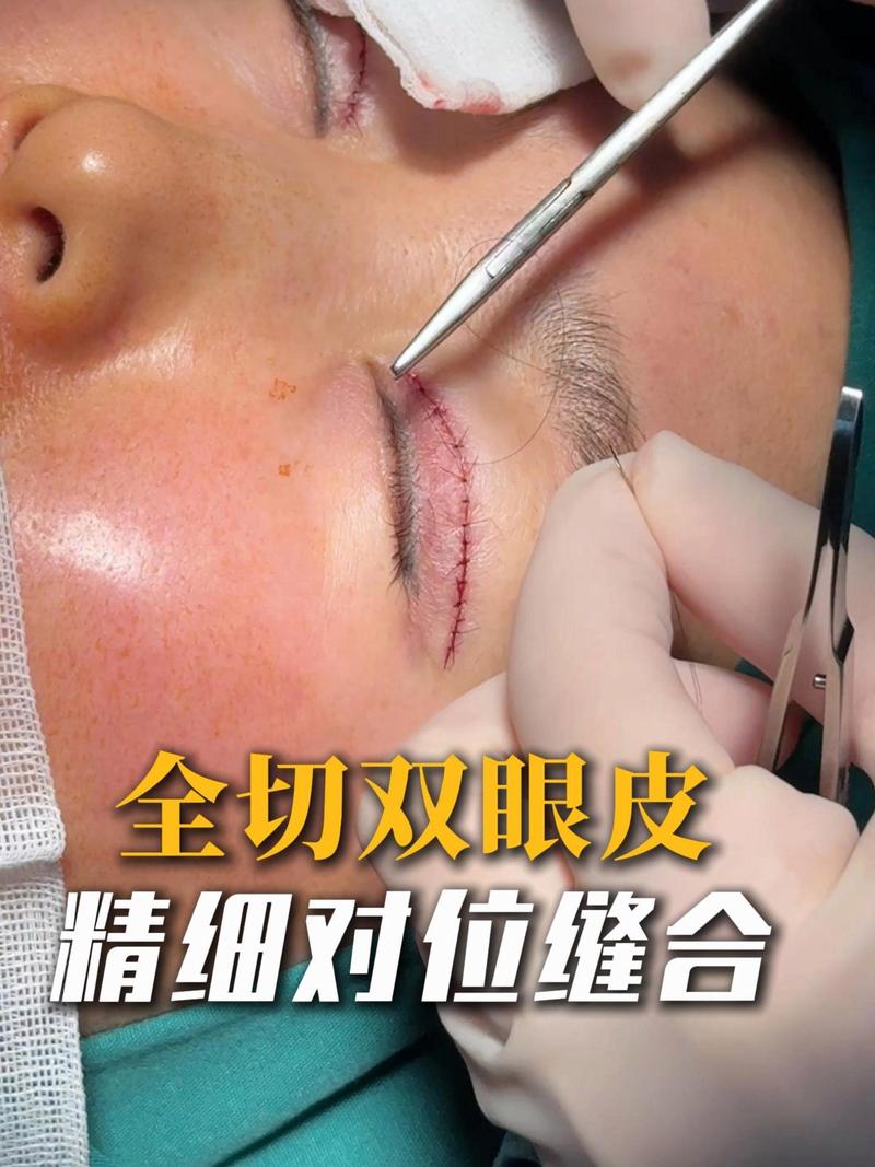 切开双眼皮手术详解及机构选择指南 切开双眼皮手术详解及机构选择指南