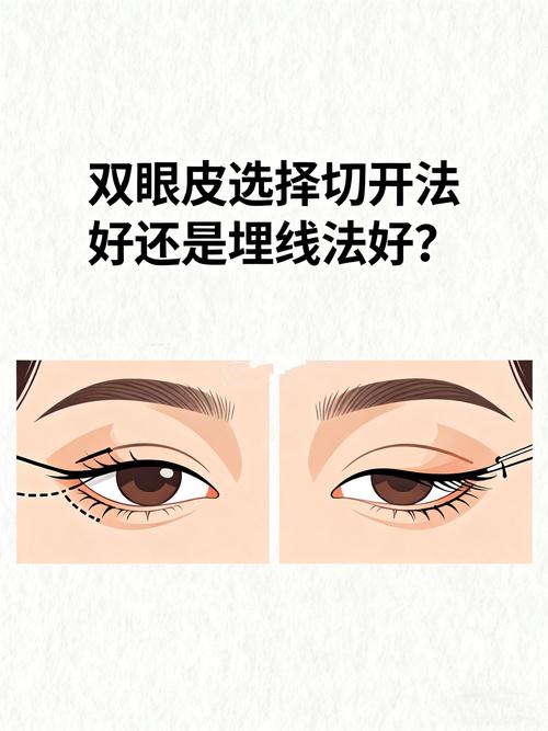 切开双眼皮手术详解及机构选择指南 切开双眼皮手术详解及机构选择指南